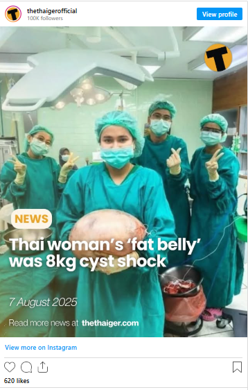 Жінка думала, що набрала вагу, а насправді потребувала негайної операції — що виявили лікарі (фото)