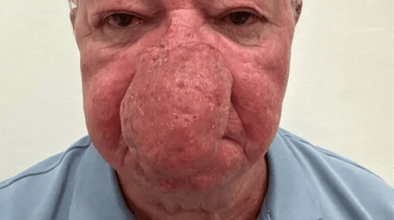 Не міг їсти, пити та цілуватися: ніс дідуся виріс до неймовірних розмірів (фото)