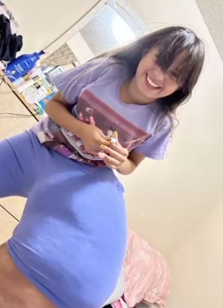 14-річній дівчинці ампутували ногу вагою 77 кг — фото