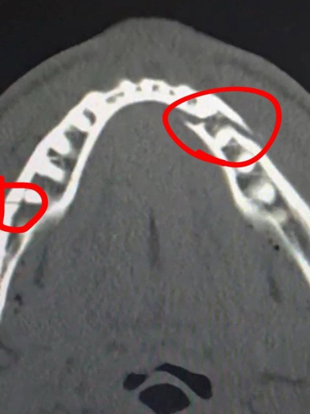 Відправив блогера до лікарні: Джошуа потужним ударом зламав щелепу Джейку Полу