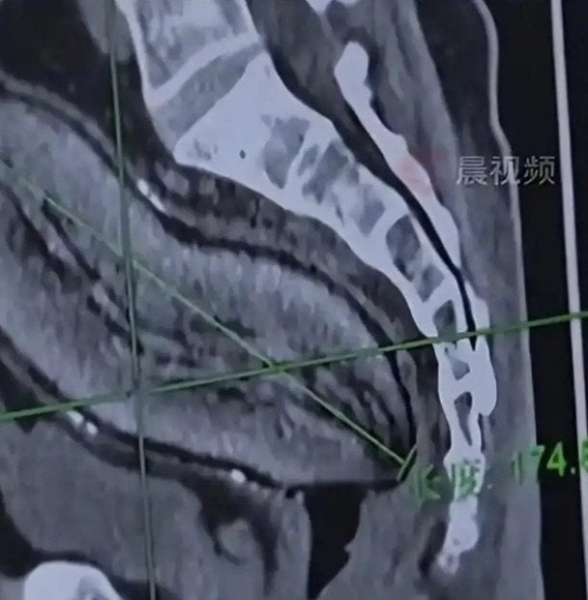 Медики шоковані: пацієнту довелося розрізати живіт через 17-сантиметрову картоплю — фото