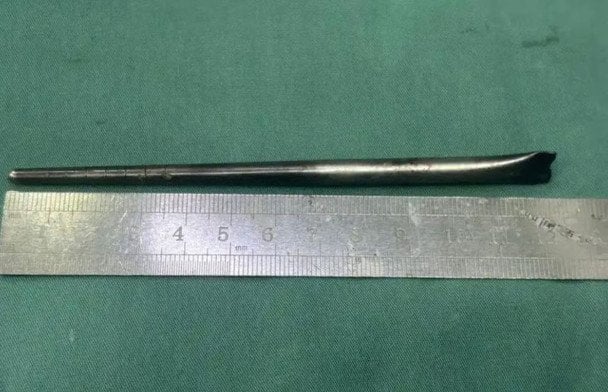 Боявся операції: чоловік 8 років жив із 12-сантиметровою металевою паличкою в горлі (фото)