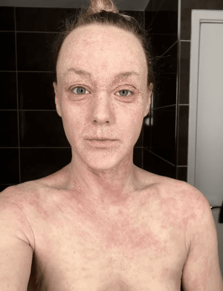 Шкіра злазить шматками: у людей з’явилось загадкове захворювання, яке не знають як лікувати