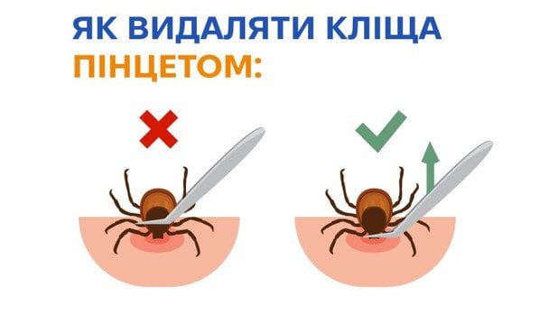 Кліщ уже вчепився, а лікарні немає: як правильно видалити та чого робити категорично не можна