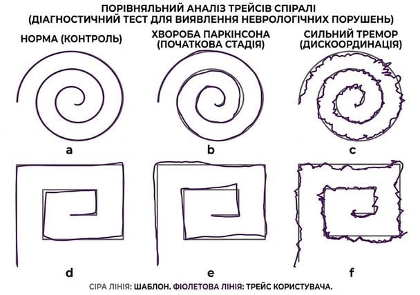Точність 99%: ШІ навчили виявляти хворобу Паркінсона за допомогою малюнків