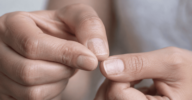 Нігті уражені псоріазом
